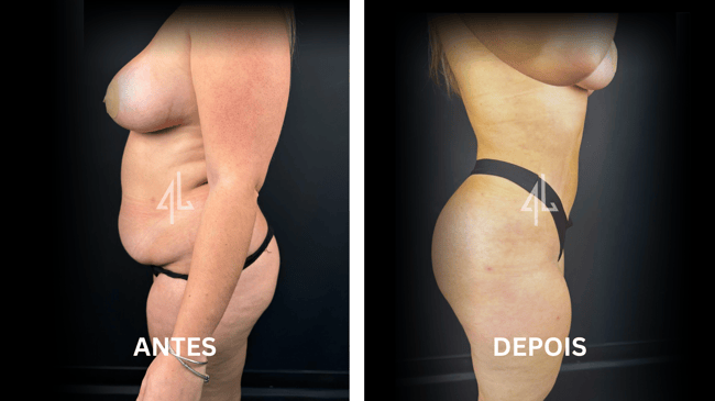 Capa #1 LipoAbdominoplastia Capa #1 LipoAbdominoplastia